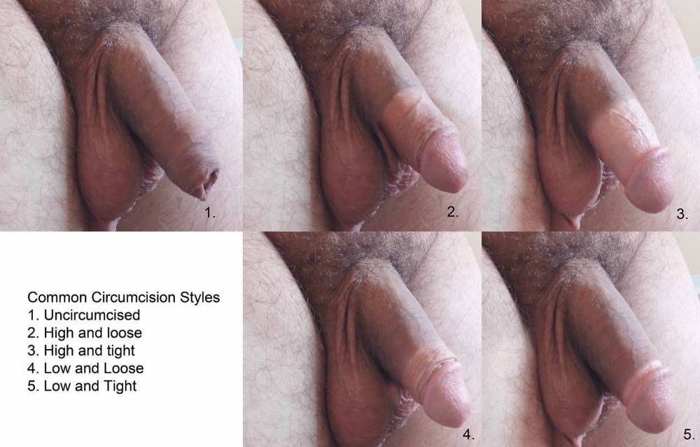 Circumcision styles.jpeg